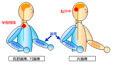 Functional Electrical Stimulation