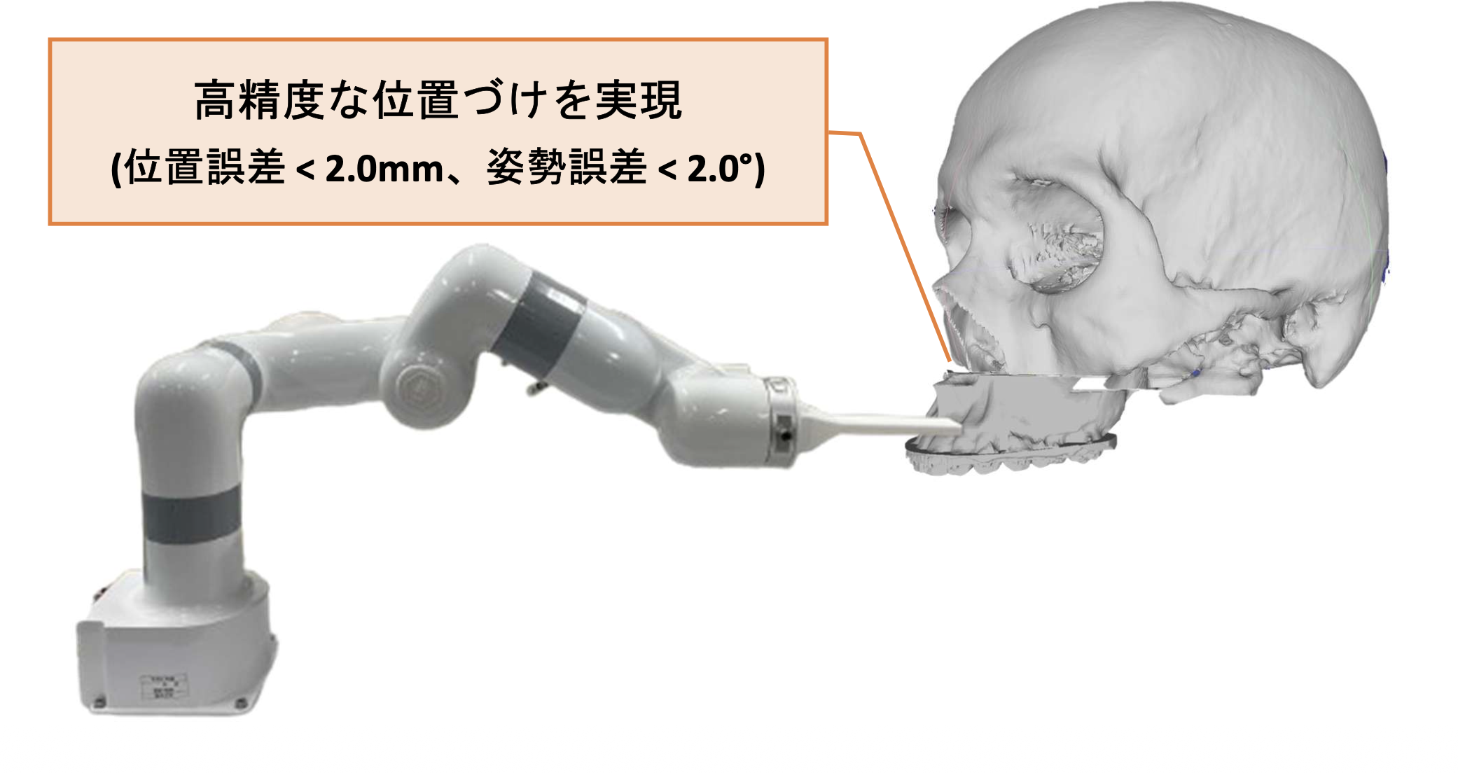ロボットアームによるLe Fort I型骨切り術の骨片位置決め支援の概要