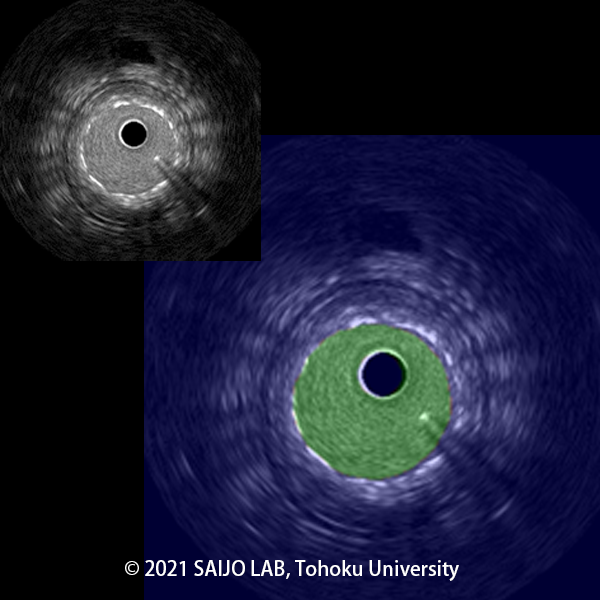 IVUSsegmentation